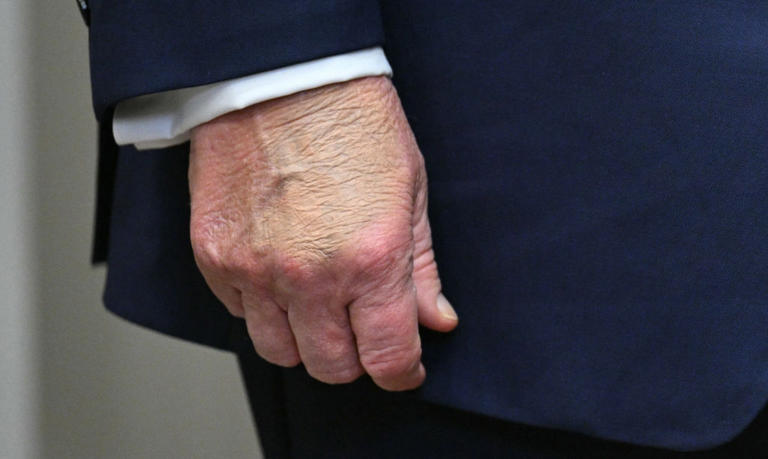 It's nearly the end of 2025, so here are pictures of Trump's hand from ...