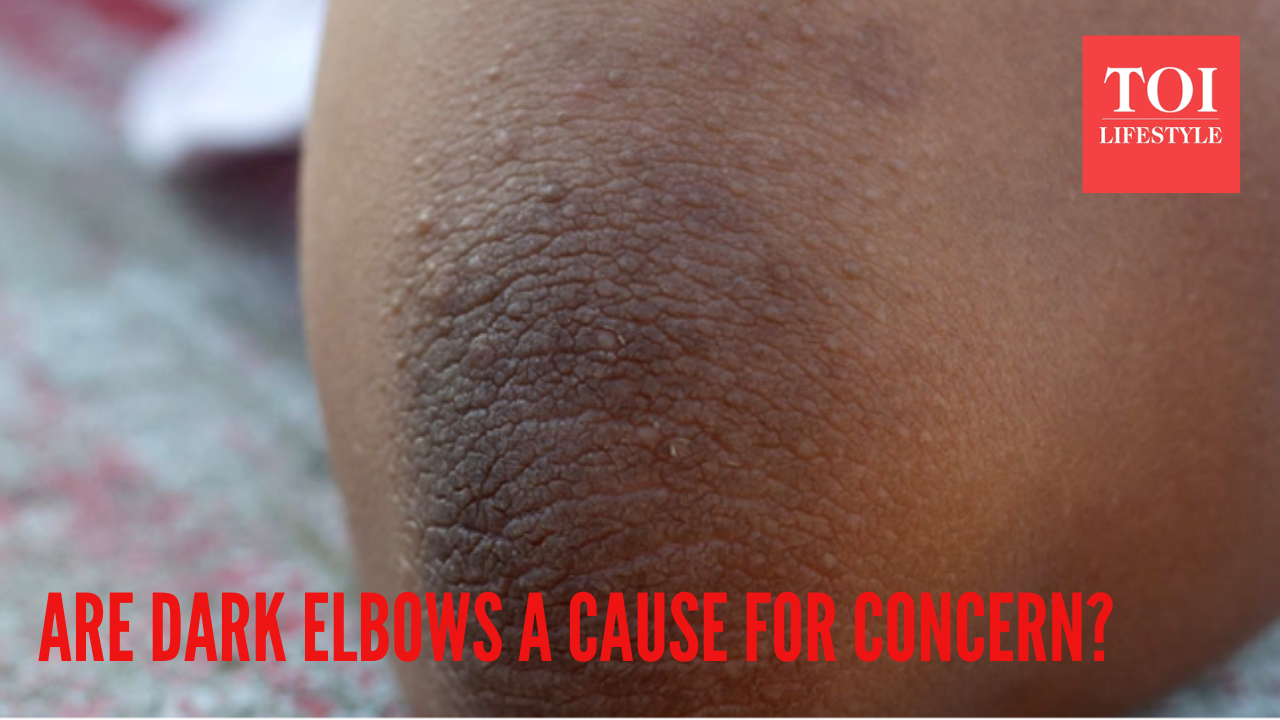 Are darkened elbows a cause for concern? Here's what it means