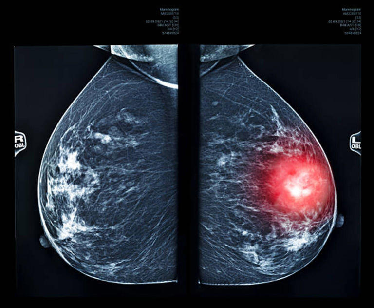 Celcuity says Revtorpyk boosts progression-free survival in breast cancer
