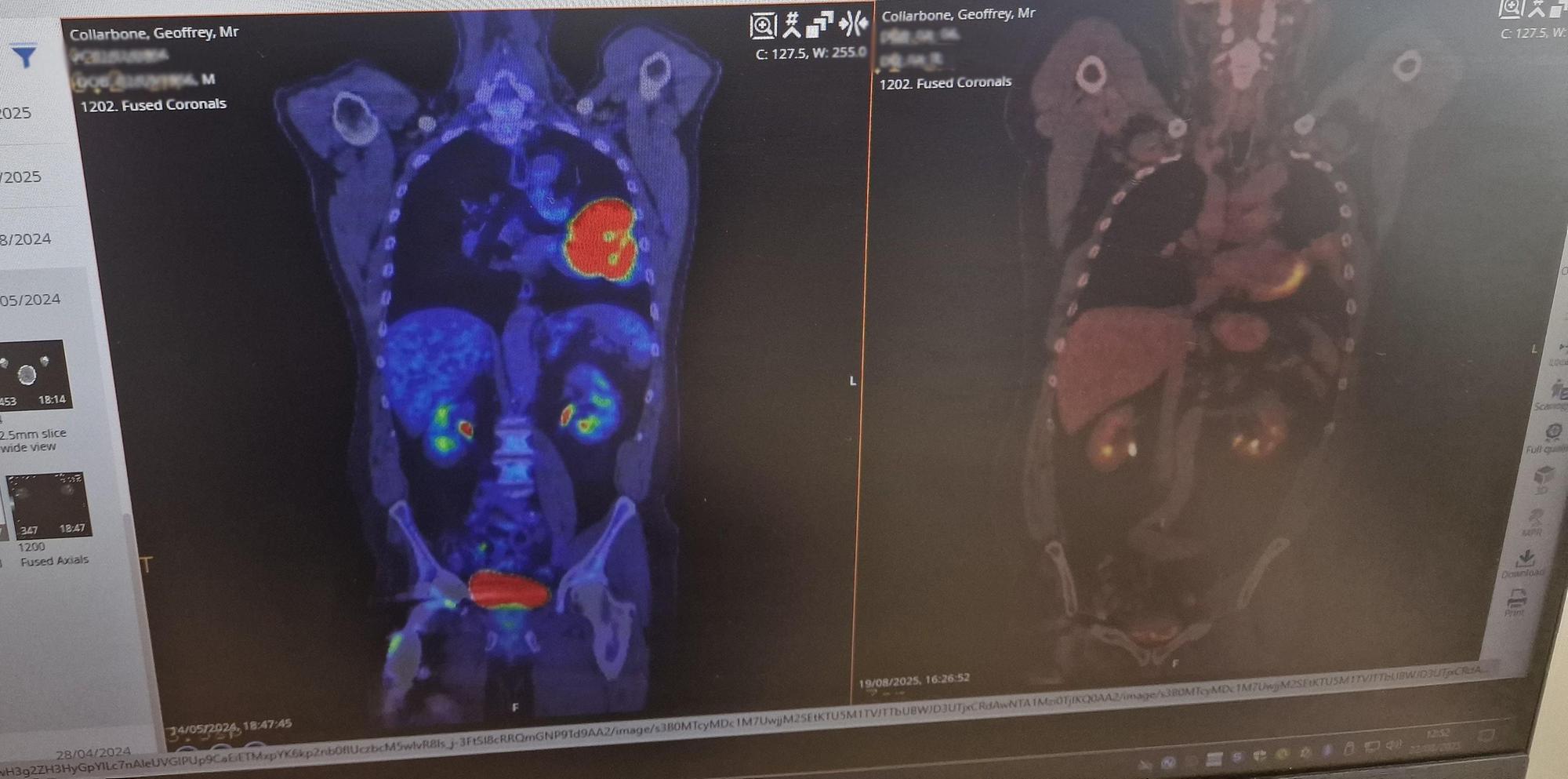 How two scans tell the story of progress in treatment for lung cancer