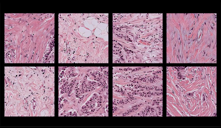 Researchers discover bias in AI models that analyze pathology samples