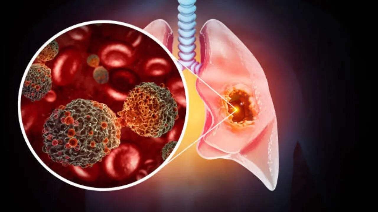 Lung cancer breakthrough: New blood test detects cancer one cell at a time