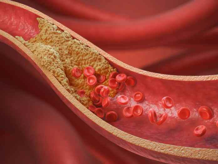 Cuatro de cada 10 adultos tienen colesterol alto y riesgo de infarto cerebral