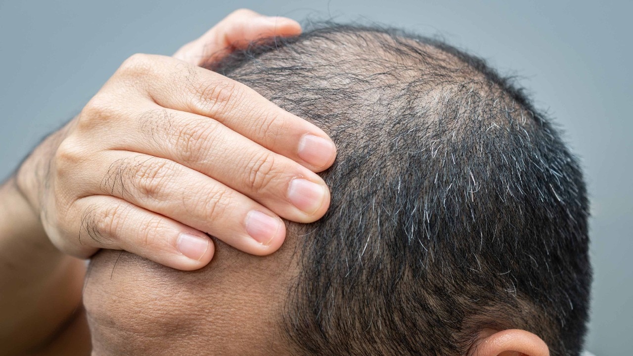 Wonder drug for male baldness puts Swiss firm Cosco's shares on steroids