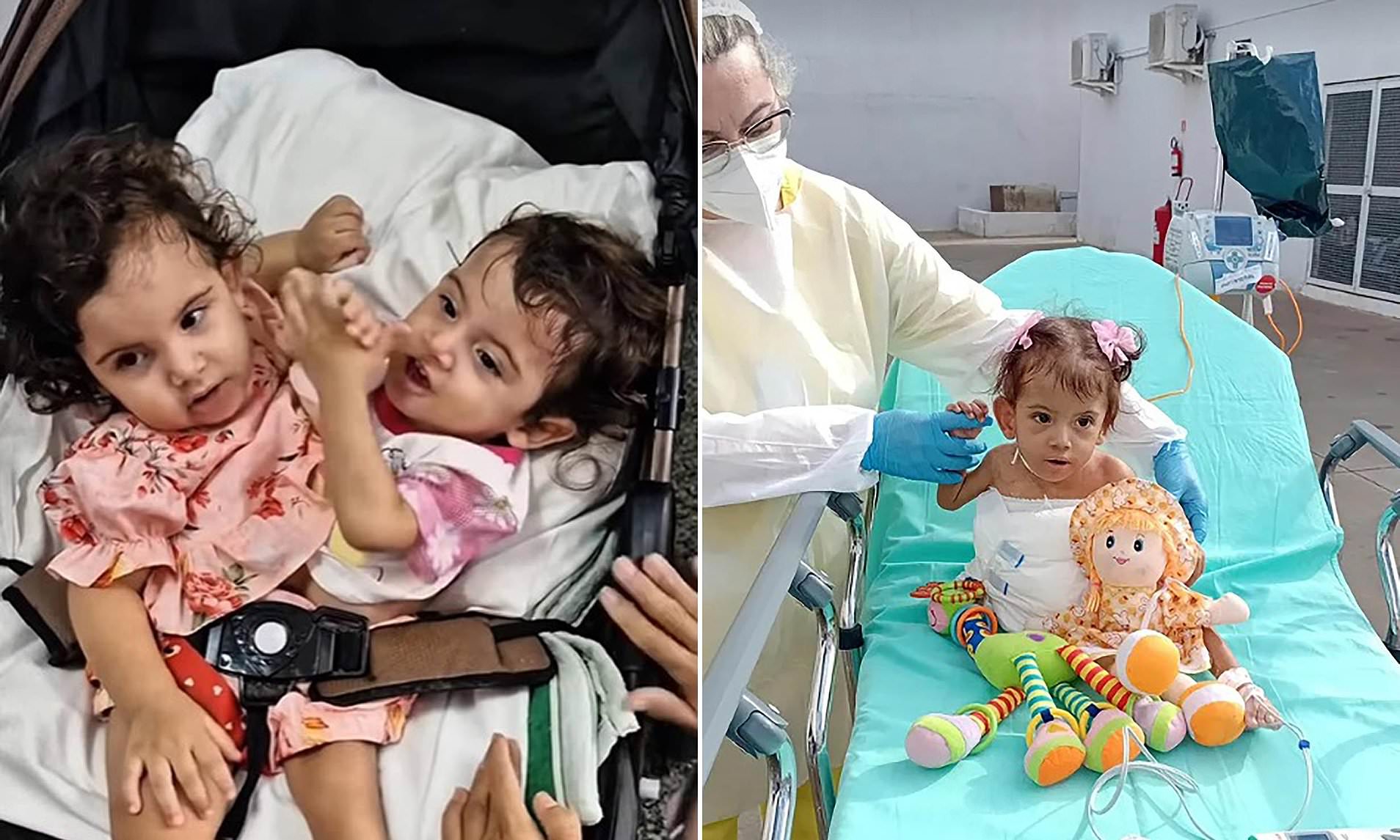 Conjoined twin dies after surviving marathon operation to separate her from her sister