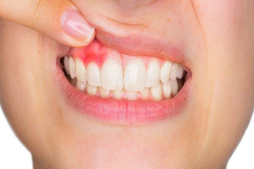 Gusi Buruk Memicu Diabetes dan Stroke pada Ibu Hamil