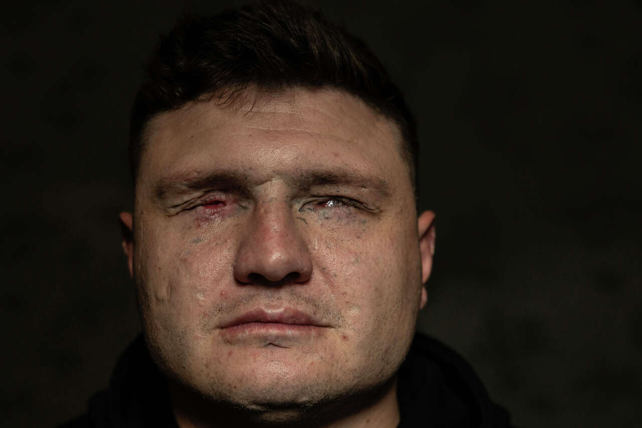 The wounds of war: Injured Ukraine soldiers heal bodies and spirits
