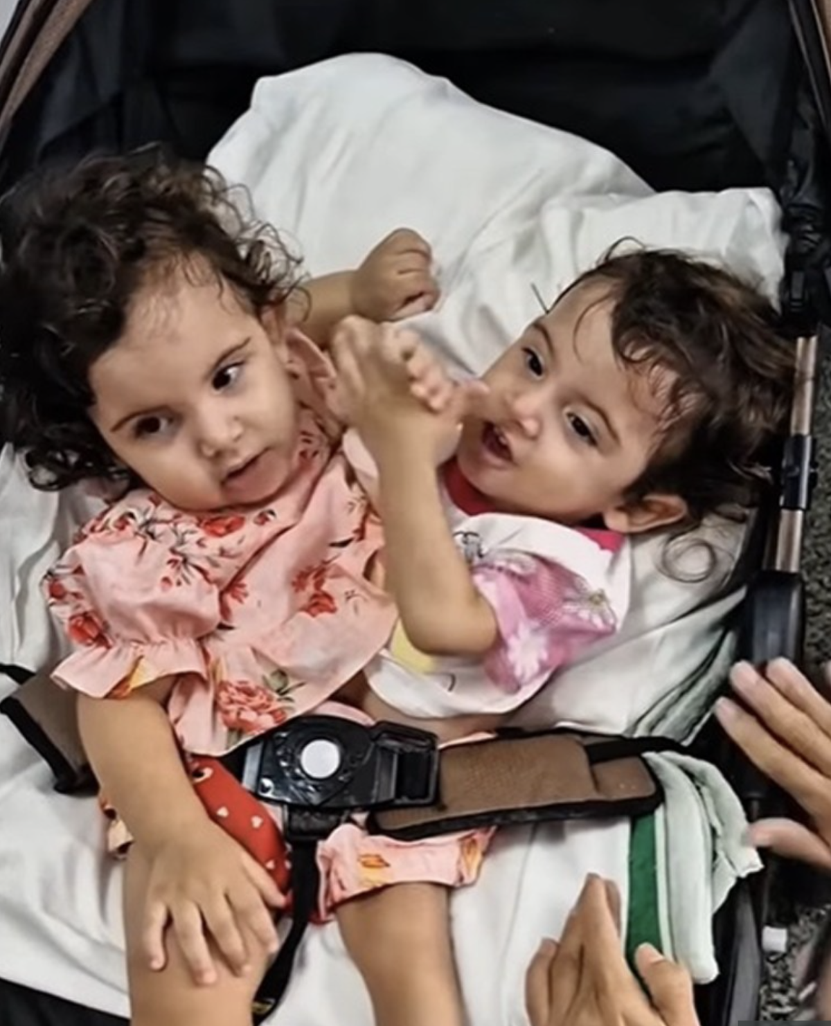 Cặp song sinh dính liền ở Brazil qua đời sau ca phẫu thuật tách rời