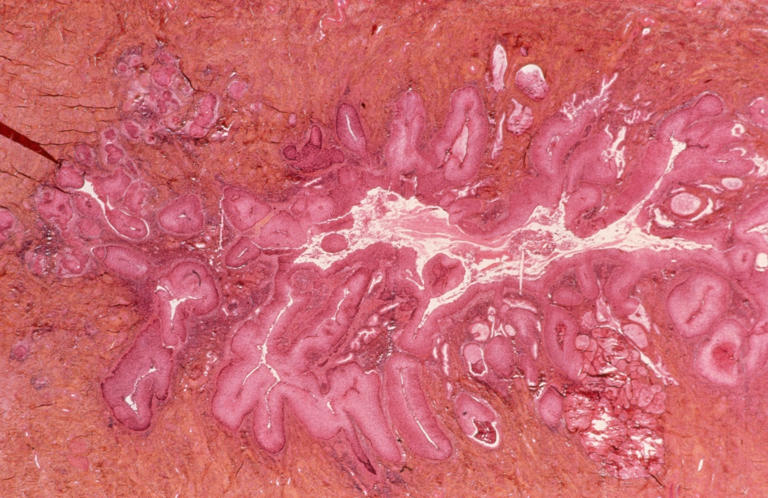 New federal screening guidance expands cervical cancer testing with at ...
