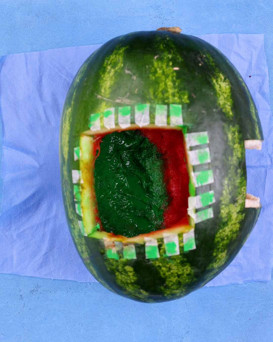 Doctors fought hard for this watermelon🍉💉