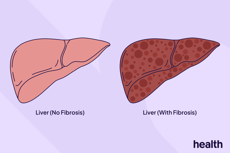 Everything you need to know about liver fibrosis