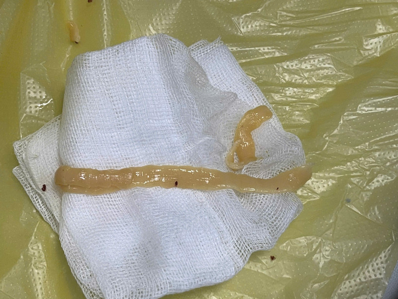 Gắp con sán dây dài gần 1 mét trong đại tràng người bệnh thích ăn đồ tái