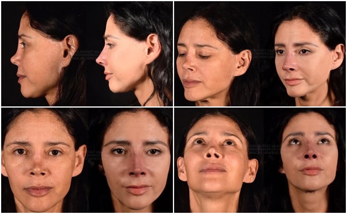 La actriz y modelo Dorismar muestra cómo quedó su nariz tras someterse a una reconstrucción nasal; fue víctima de una mala cirugía estética.