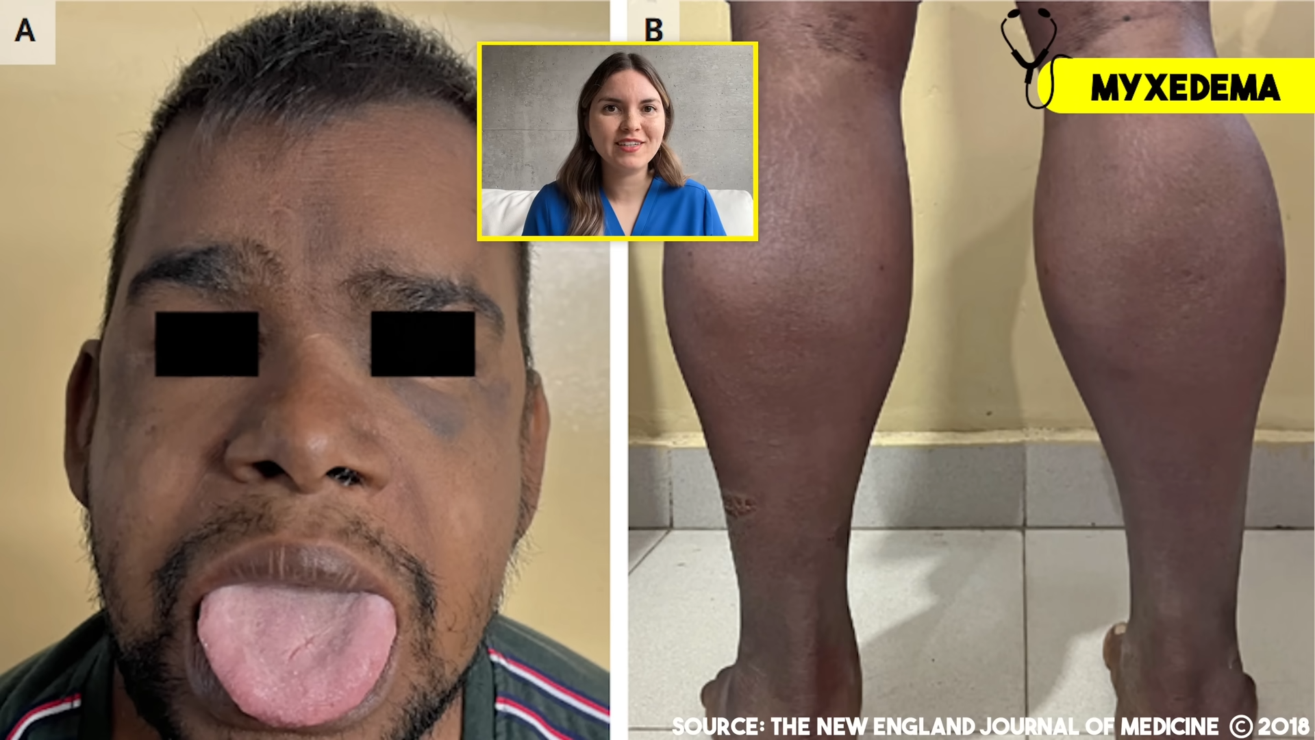 This isn’t just dry skin - the ‘crazy paving’ pattern linked to an ...