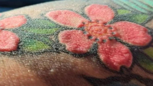 Tattoo Triggers Rare Condition: Man Loses Hair and Can’t Sweat—Doctors Explain Anhidrosis