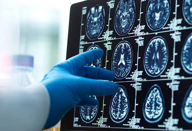 Demência pouco conhecida pode explicar casos antes atribuídos ao Alzheimer