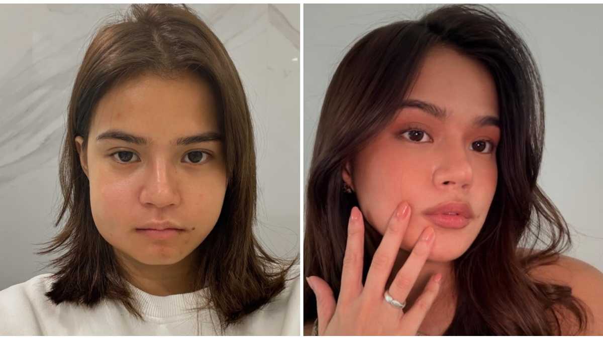 Maris Racal shares photos of her with swollen cheek: 