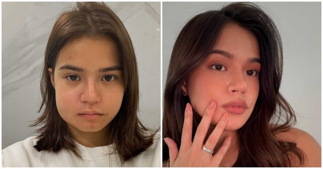 Maris Racal shares photos of her with swollen cheek: 