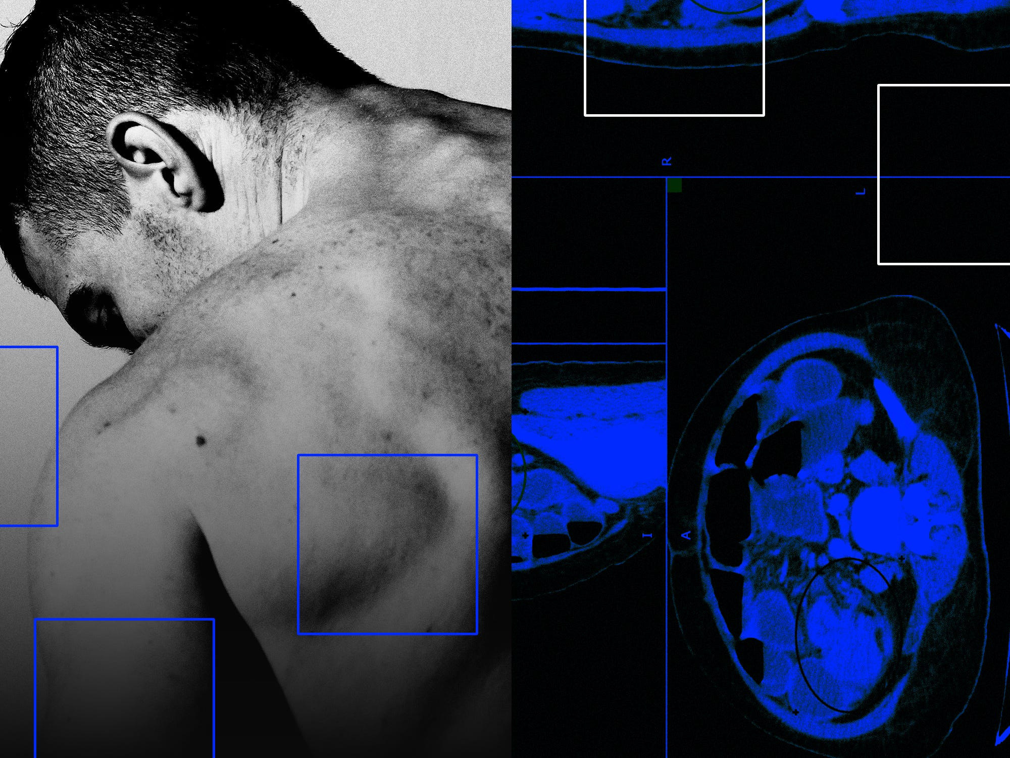 What causes earlyonset colon cancer? New research offers clues