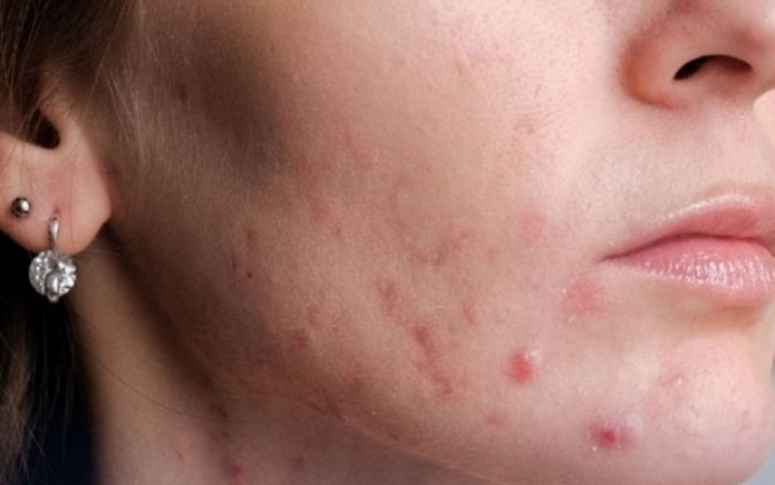 Nhận biết gan nhiễm mỡ sớm qua thay đổi bất thường trên gương mặt