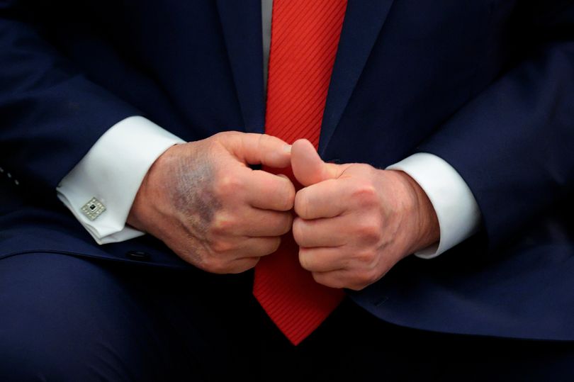 Trump reveals reason for mysterious bruised hands as new health fears grow