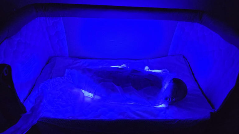 How newborns with jaundice can receive vital treatment at home