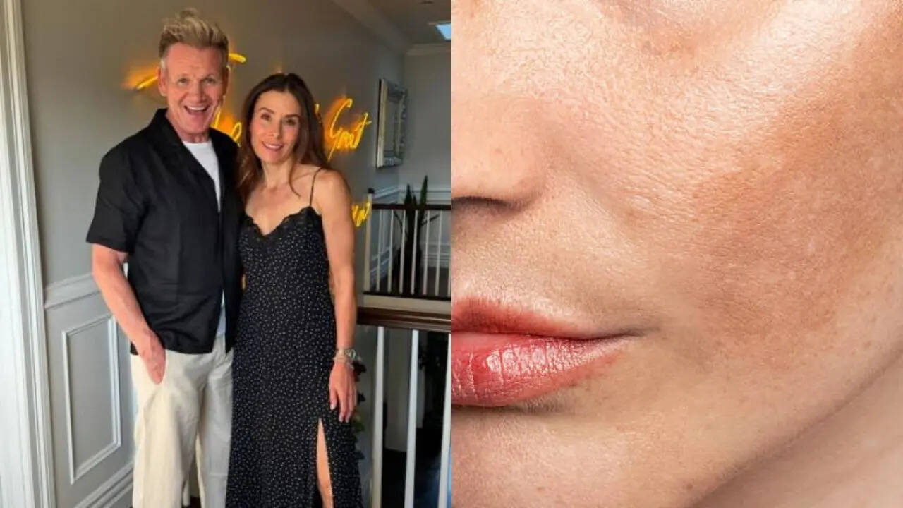 Gordon Ramsay’s wife Tana reveals melasma after sun exposure—what is ...