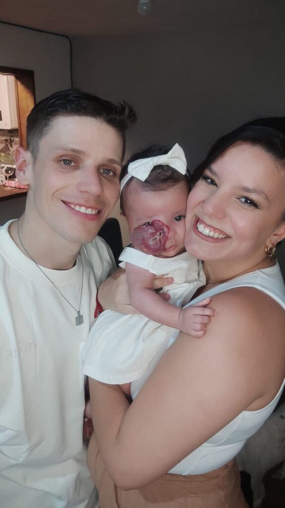 Tiny baby’s tumour was so large it moved her nose