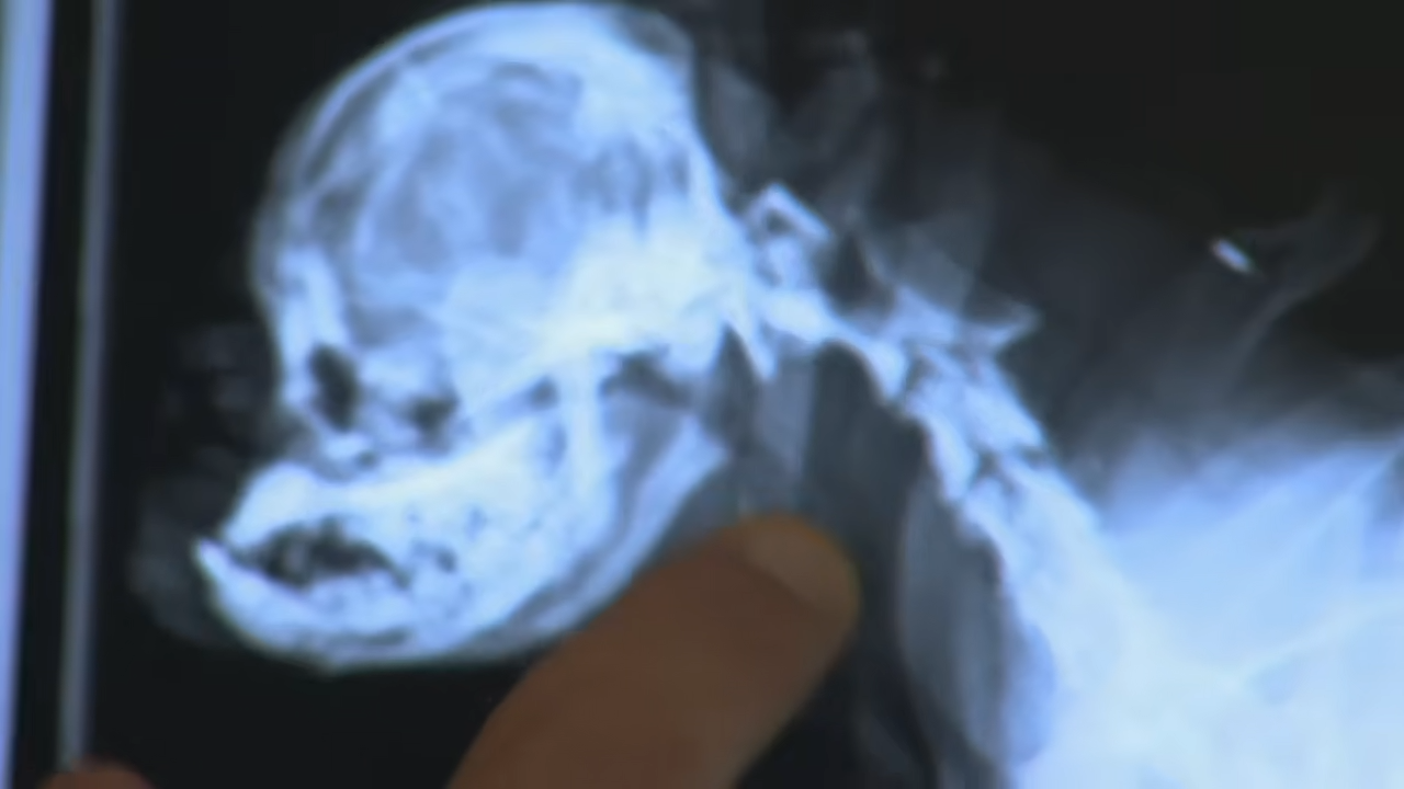 How one X-ray changed everything and revealed a pelvis completely smashed