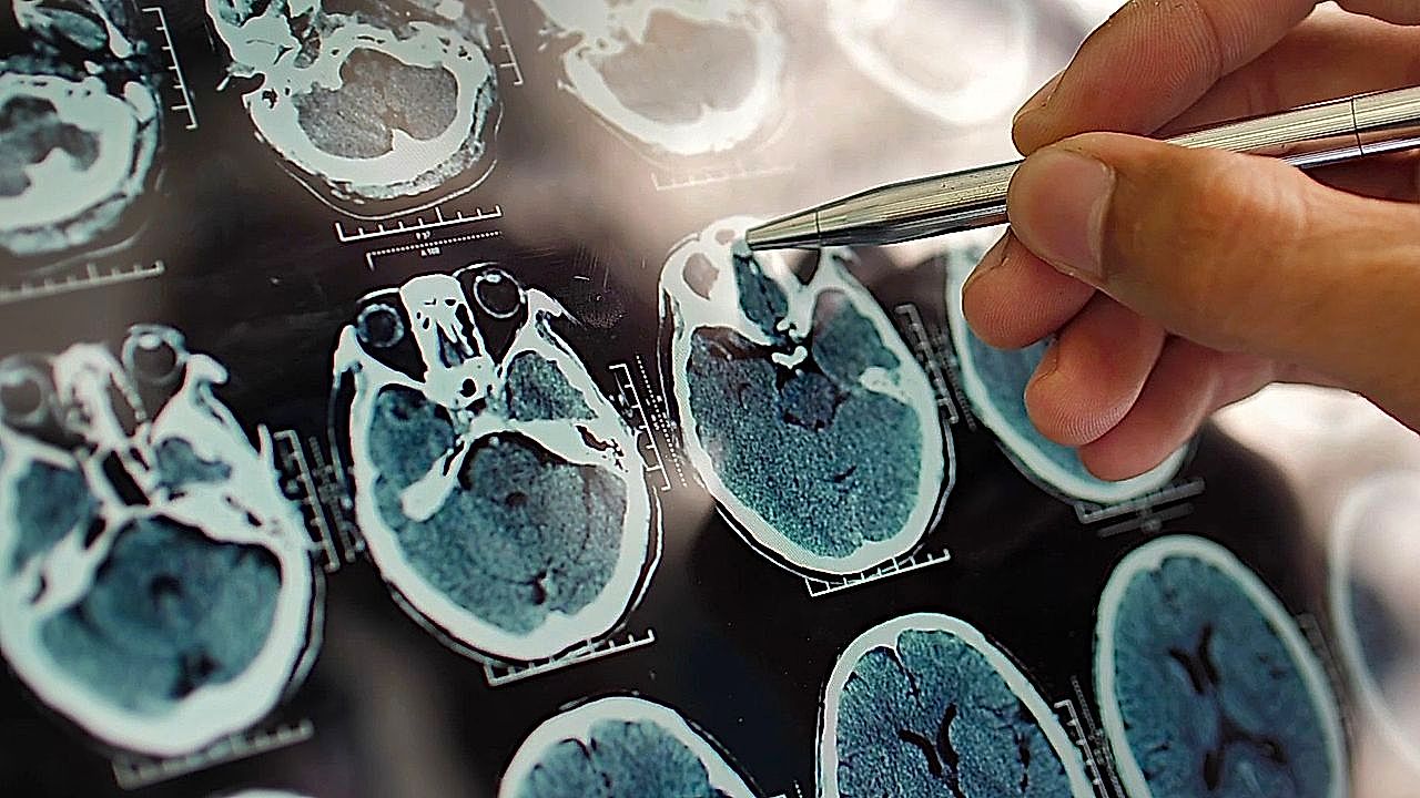 Un nouveau test sanguin pourrait détecter la maladie d'Alzheimer
