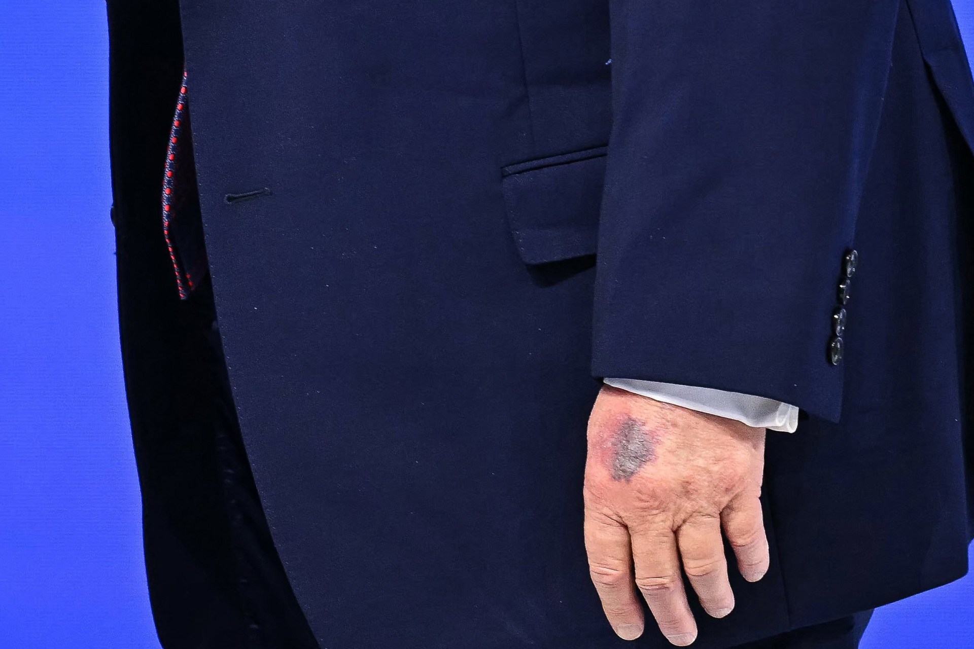 Trump sparks speculation over new hand bruise at Davos