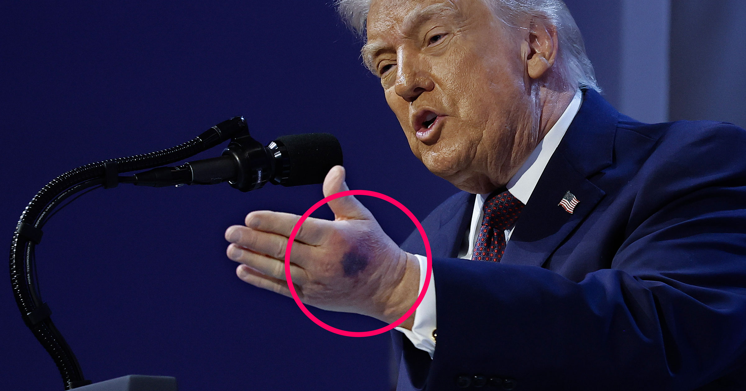 Trump’s other hand is also now showing a grisly mark