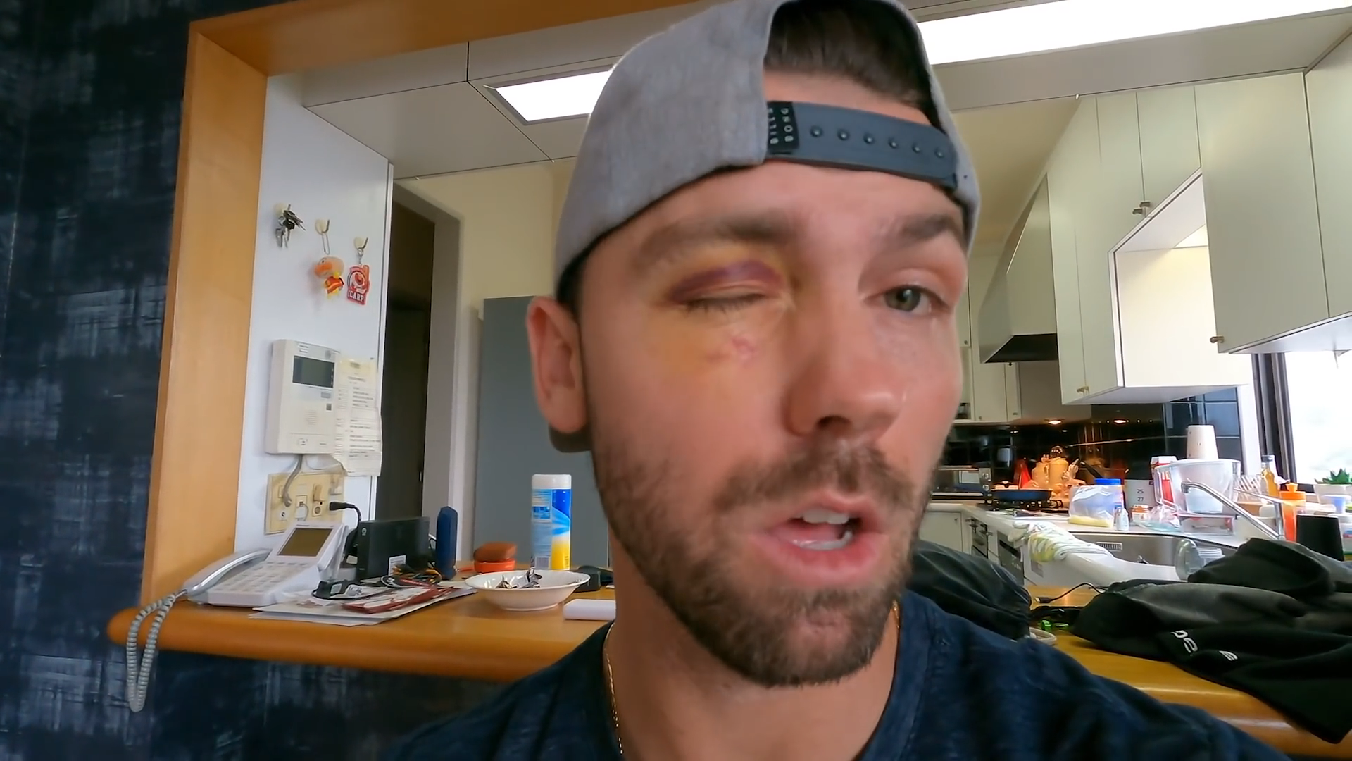 This baseball injury happened in a split second
