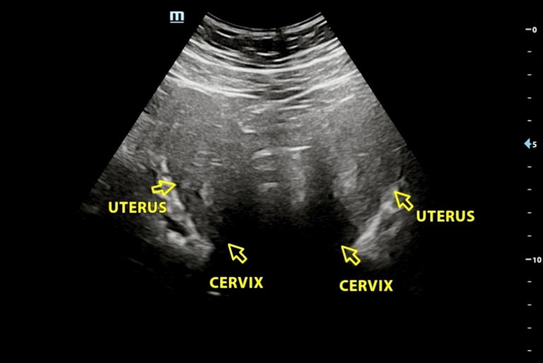 Woman discovers her womb is split into two cavities