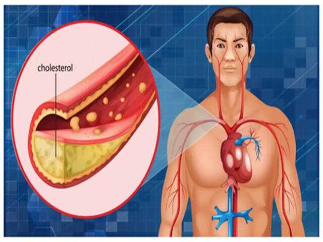 Understanding high cholesterol: Risks and management strategies