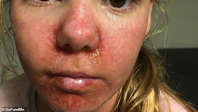 Sisters battling rare skin condition forced to hide under UV-safe ...