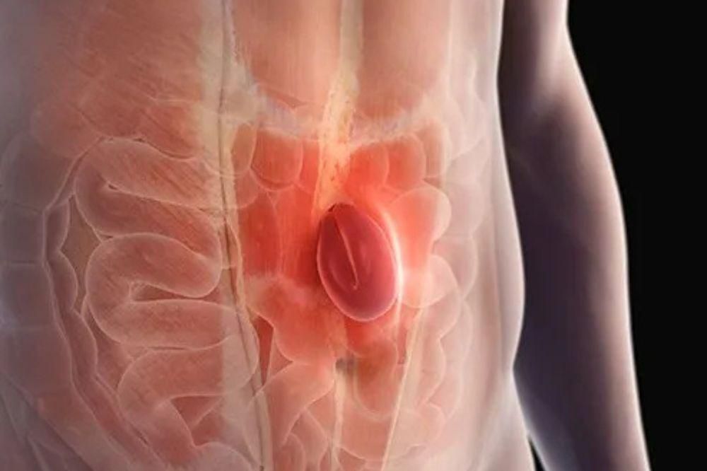 – Apa yang Terjadi Jika Hernia Dibiarkan? Bisa Mengancam Jiwa