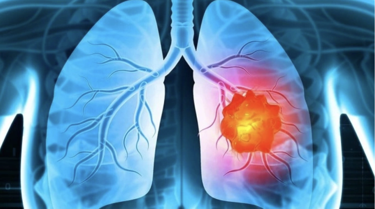 Ứng dụng AI chẩn đoán ung thư phổi sớm