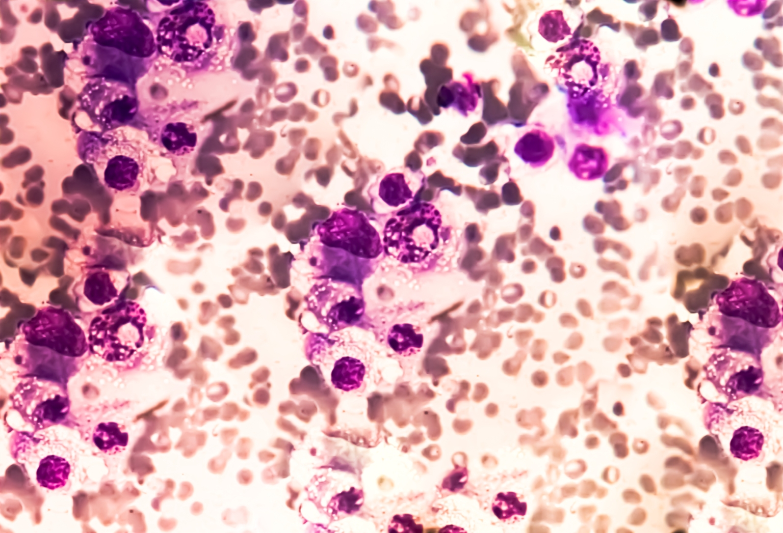 J&J's Darzalex Faspro gains another multiple myeloma indication
