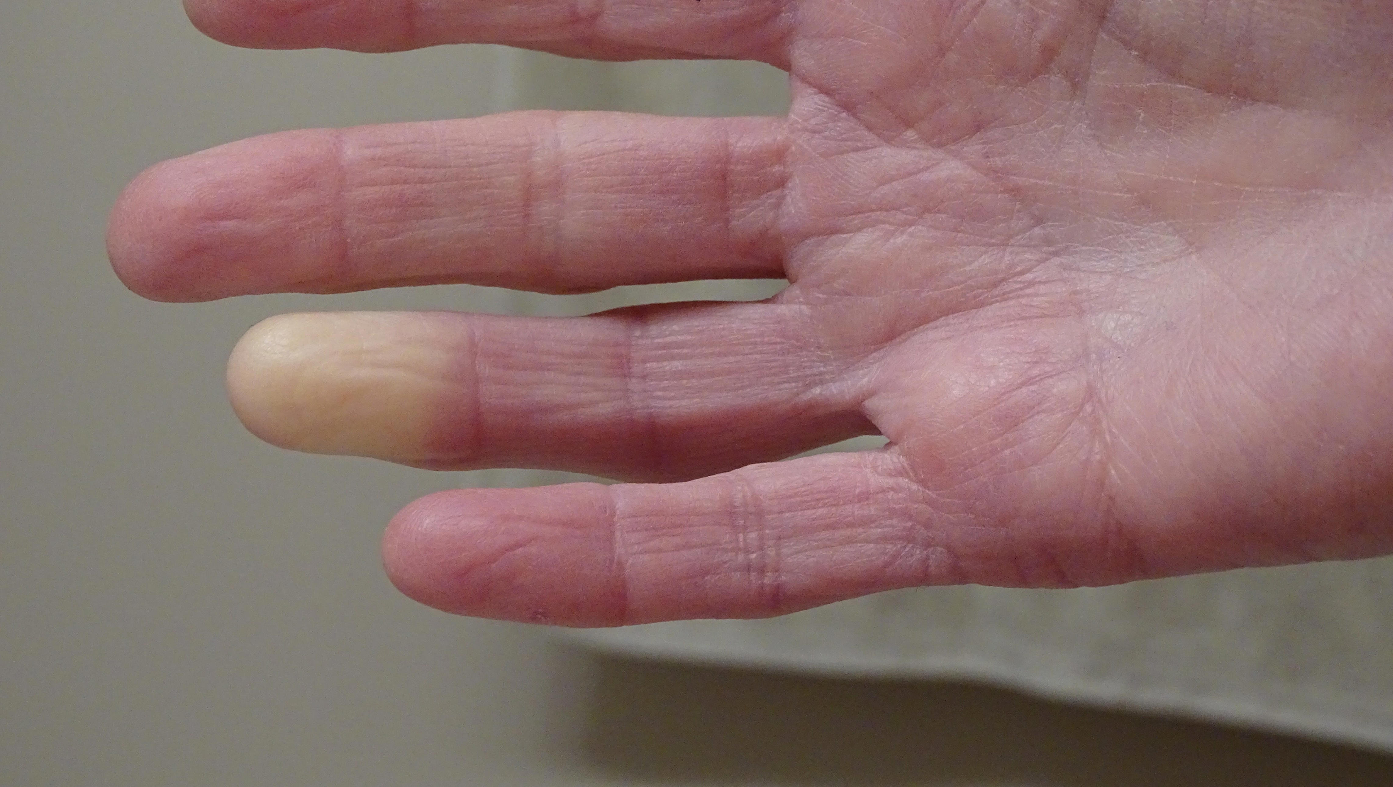 Doctor explains causes of cold hands, when to seek care