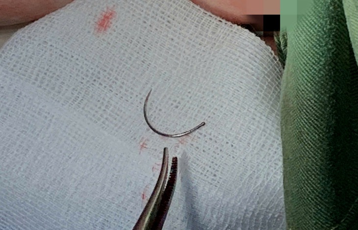Lấy dị vật kim khâu nằm trong tầng sinh môn nữ bệnh nhân sau 11 năm