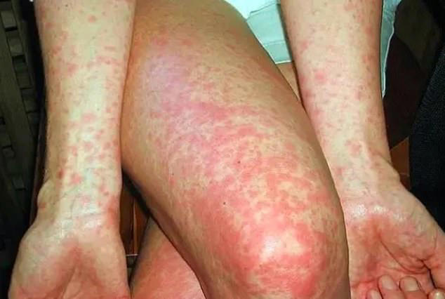 Urgent warning as disease spreads in one Aussie state - and the ...
