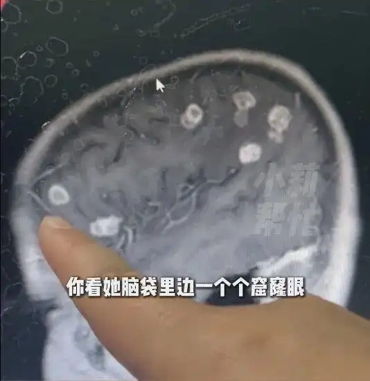 Bé gái bị nấm 'ăn não' khi dọn nhà đón Tết