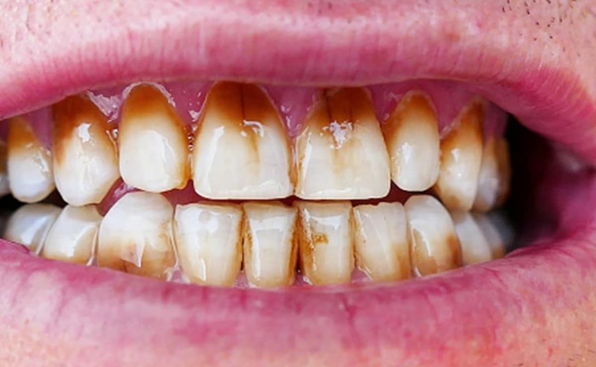 Dentist explains why your teeth enamel matters, 11 reasons it wears off
