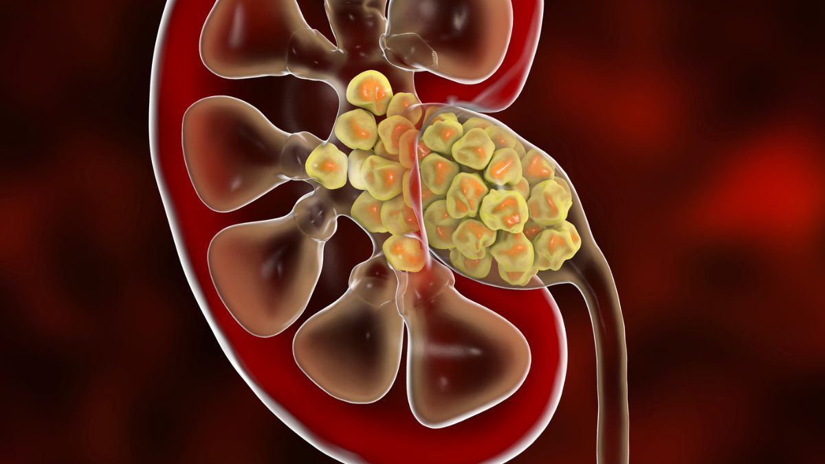 Surprising find inside kidney stones suggests we were wrong about how ...