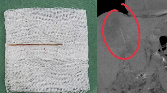 Biến chứng nguy hiểm từ thói quen ngậm tăm tre sau bữa ăn