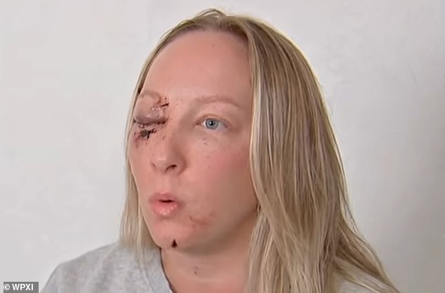 Madeline Grace, 29, suffered grave facial injuries when a massive chunk of ice flew off a tractor-trailer and smashed through her windshield