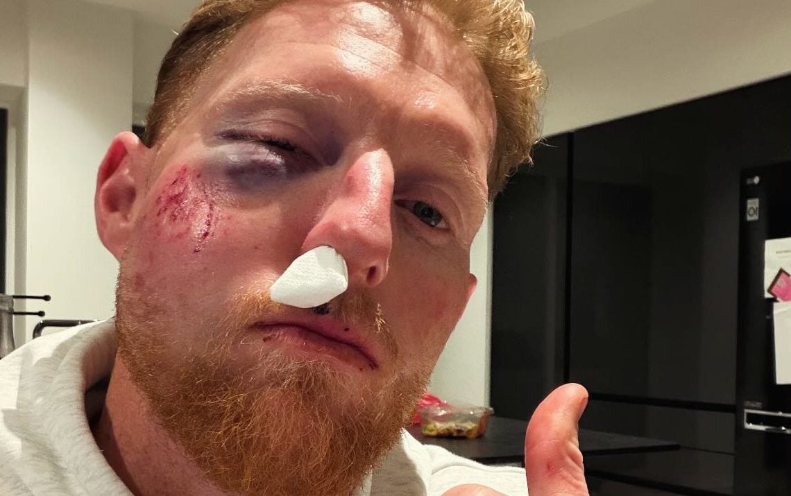 Pictured: Ben Stokes suffers facial injuries after being 