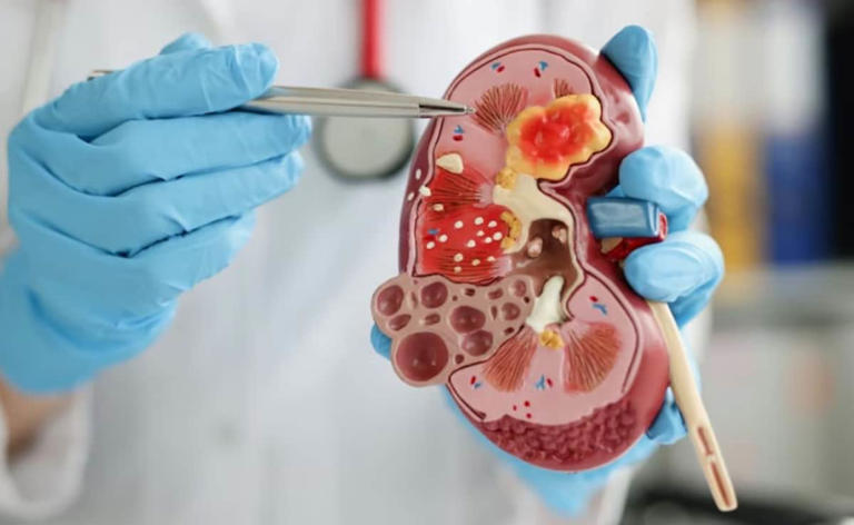 Kidney disease warning signs: 7 surprising risk factors other than ...