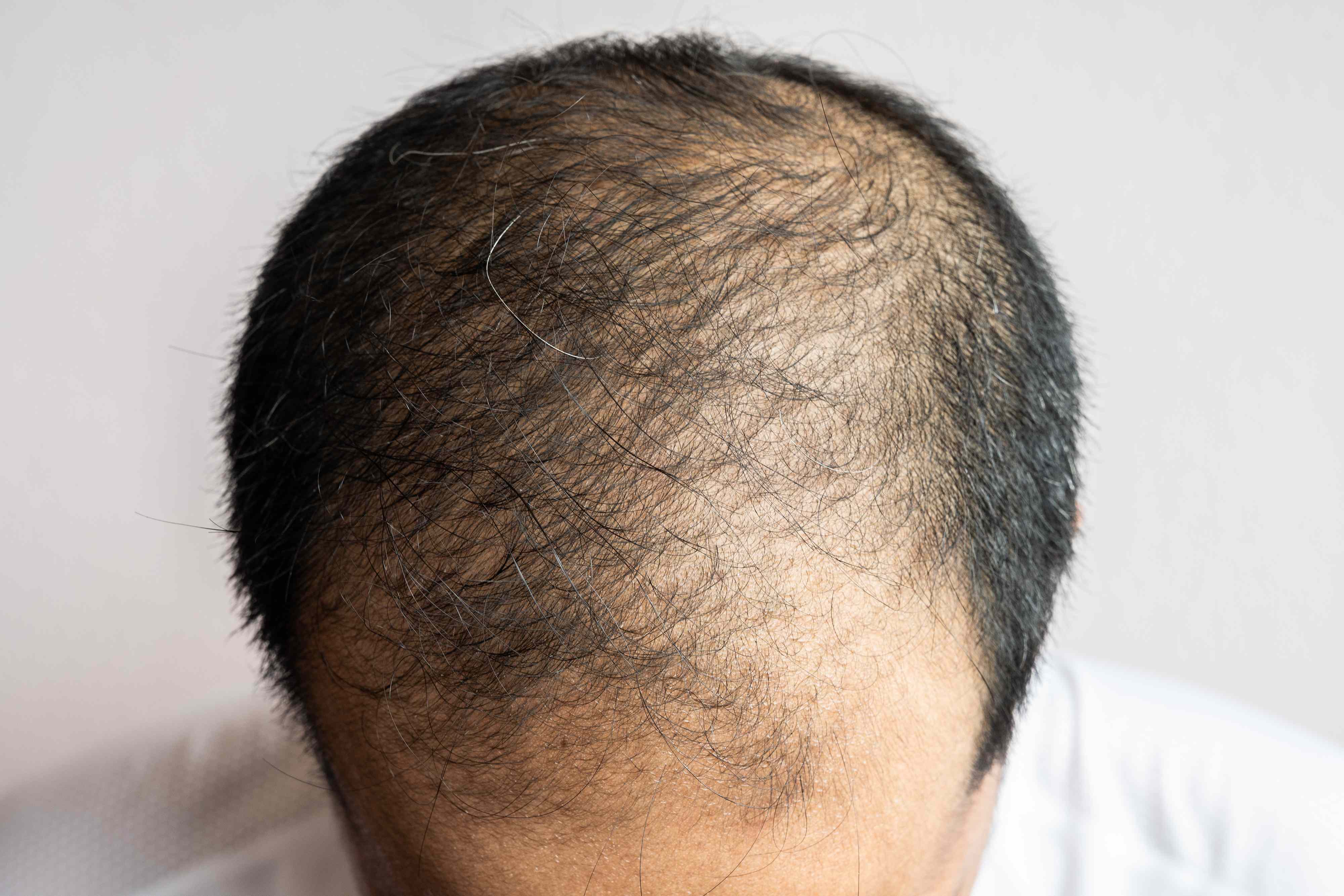 How dihydrotestosterone (DHT) causes hair loss